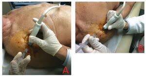 Image result for Biceps Tendon Injection