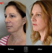 Neck lift with hidden incisions behind the ears and a small one under the  chin for platysmaplasty. These photos show our beautiful patient 5 days  post-surgery, during the expected swelling and bruising