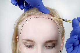 Top 36 trending and most stylish faux hawk haircuts of 2019. Les Implants Capillaires Sont Douloureux Vrai Ou Faux