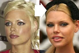 Celebrity Plastic Surgery Photos