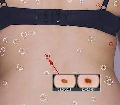 Mole mapping isn't necessary unless you are at high risk of melanoma. Skin Cancer Detection Mole Mapping In Port Elizabeth Dr Katherine York
