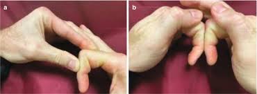 Image result for Elson Extensor Tendon Test