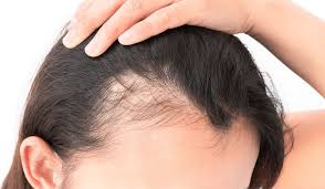 Si cette perte de cheveux dure moins de 6 mois on parle d 'une perte de cheveux aiguë. Greffe De Cheveux Chez La Femme