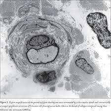 Dejerine Sottas Disease A Case Report