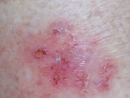 Check spelling or type a new query. Discoid Eczema Images Dermnet Nz