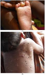 Image result for scabies human children