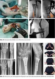Im lateralen bereich (ellenseitig) befindet sich. Die Korrekturosteotomie An Der Distalen Speiche Orthopadie Traumatologie Universimed Medizin Im Fokus