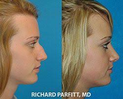 Facial Plastic Surgery Madison, WI