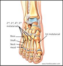 Specific types of metatarsal fracture include an avulsion fracture, where the tendon of the peroneus brevis muscle pulls a piece of the bone away. Metatarsal Fractures Orthopaedia