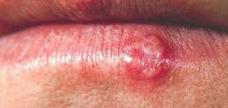 ترجمة و معنى و نطق كلمة lupus (الإنجليزية <> العربية) | قاموس ترجمان , , , , , , , , , , , , , , , , , , , , , , Ø§Ù„Ø°Ø¦Ø¨Ø© Ø§Ù„Ø­Ù…Ø±Ø§Ø¡ ÙˆØ§Ù„Ø¬Ù‡Ø§Ø² Ø§Ù„Ø¹ØµØ¨ÙŠ Ø§Ù„Ù…Ù†Ø¯Ø¨