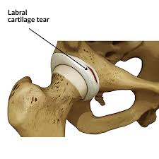 Image result for Hip Labral Tear