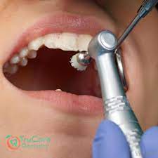 Everything That You Should Know About Fluoride Treatment Trucare Dentistry Roswell