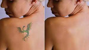 At miss laser, our certified laser technicians are committed to providing you with the latest laser technology and the most effective laser hair removal…. Laser Tattoo Removal York Medical Spa