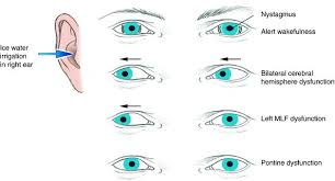 Image result for Oculovestibular Testing