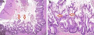 Cureus Low Grade Appendiceal Mucinous Neoplasm In The Context Of Acute Appendicitis