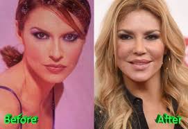 Brandi Glanville Before And After Cosmetic Surgery Cosmetic Surgery Plastic Surgery Celebrity Plastic Surgery