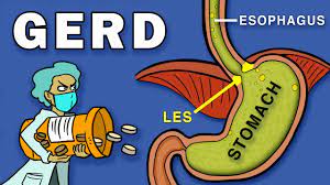 Efficacy and safety of esomeprazole compared with omeprazole in gerd patients with erosive esophagitis: Gastroesophageal Reflux Disease Gerd Youtube