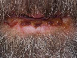 How can the wind burn the skin? Windburn Definition And Remedies