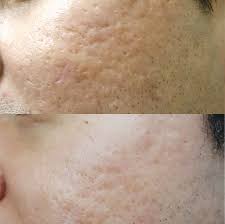 Before & After - Juvelook & Lenisna