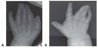 Image result for Syndactyly
