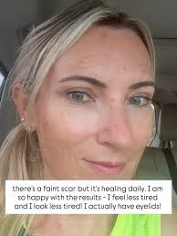 3 months ago I made the decision to do something about my very droopy  eyelids and booked in for blepharoplasty (still can't say that word!) with  @drmaurizioviel @cornerstoneclinics