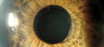 Que son las cataratas en los ojos. Que Son Las Cataratas Y Que Sintomas Tienen Imo