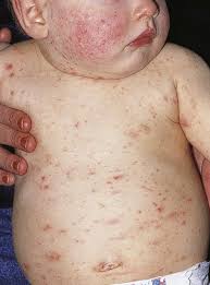 Image result for scabies human children