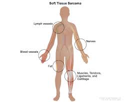 Soft Tissue Sarcoma Treatment - NCI