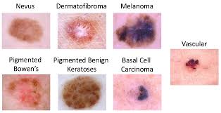 Benign skin lesions strategies for removing benign skin lesions include chemical and thermal cautery, curettage with or without cautery, shave excision, snip they are almost always multiple and have a characteristic stuck on appearance (figure 6). Task 3 Lesion Diagnosis Isic 2018