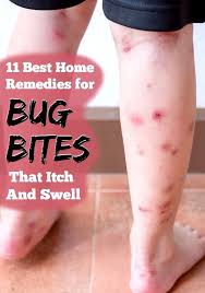 Bug Bites That Look Like Mosquito Bites But Aren T 11 Best Home Remedies For Bug Bites That Itch And Swell Bug Bites Remedies Remedies Home Remedies