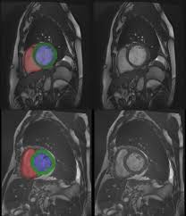 Image result for Cardiac MRI