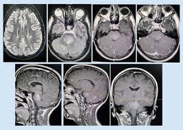 Mri is the imaging modality of choice for the assessment of patients with suspected brainstem the appearance of clippers on mri is fairly unique, characterized by multiple punctate, patchy and. Case Report With Review Of Literature For The Dilemma Of Diagnosis Of Clippers Future Neurology