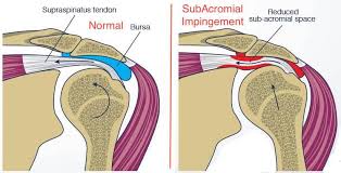 Image result for Subacromial Space Injection