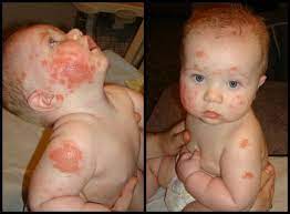 Coeliac Symptoms Toddler Poslednie Filmy