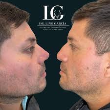 Lino García |Rinoplastia