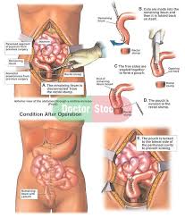 Ileorectal Anastomosis Surgery Construction Of A J Pouch Pediatric Surgery Surgery Ostomy Life