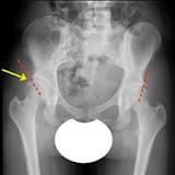 Image result for what hip dysplasia causes symptoms and treatment