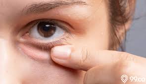 Penyebab terjadinya iritasi mata sendiri diketahui cukup beragam dan visine adalah salah satu jenis obat tetes mata yang dapat menyembuhkan iritasi mata merah dan salah satu cara untuk mengatasinya adalah menggunakan obat seperti cendo lyteers ini. 10 Cara Mengatasi Mata Bengkak Akibat Menangis Dan Iritasi