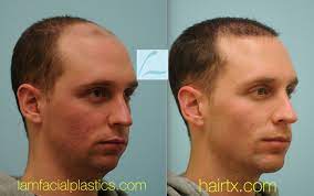 Pin By Hairtx On Male Hair Transplant Results Hair Transplant Results Hair Transplant Mens Hairstyles