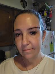 2 weeks post op. Stitches are out, swelling is minimal and Dr said it all  looks good.