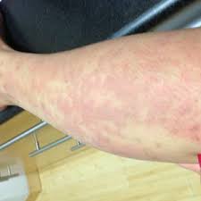 The total cost of laser hair removal depends on several factors, including who performs the treatment. How To Get Rid Of Warm And Itchy Red Bumps Days After Laser Hair Removal Photo