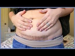 Coping With My Birth 2 Weeks Postpartum Postpartum Belly Postpartum C Section Belly