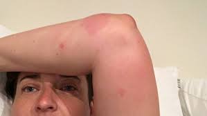 Spider bites do not produce many. I Slept Through Seven White Tail Spider Bites But The Pain Will Last Forever Stuff Co Nz