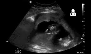 We at baby ultrasound co use new cutting edge ultrasound technology to bring images of your baby to life. Selective Reduction Wikipedia