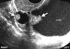 But these scans can't determine whether the abnormality is cancer. Imaging Strategy For Early Ovarian Cancer Characterization Of Adnexal Masses With Conventional And Advanced Imaging Techniques Radiographics