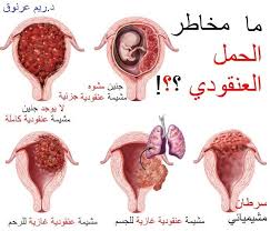 ما مخاطر الحمل العنقودي للحمل العنقودي دكتورتي ريم عرنوق فيسبوك