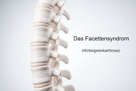 Praxis Fur Schmerztherapie Wegberg Facettensyndrom 2 Ubungen Gegen Ruckenschmerzen Facebook
