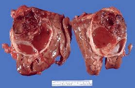 Renal Pathology- Carcinoma-Types of carcinomas- | Homeopathic | Best Homeopathic Doctor in Pakistan | Dr Qaisar Ahmed MD, DHMS