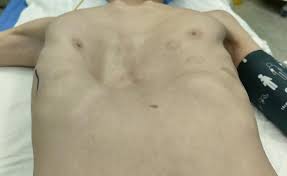 Image result for Pectus Excavatum
