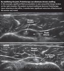 Image result for Biceps Tendon Injection